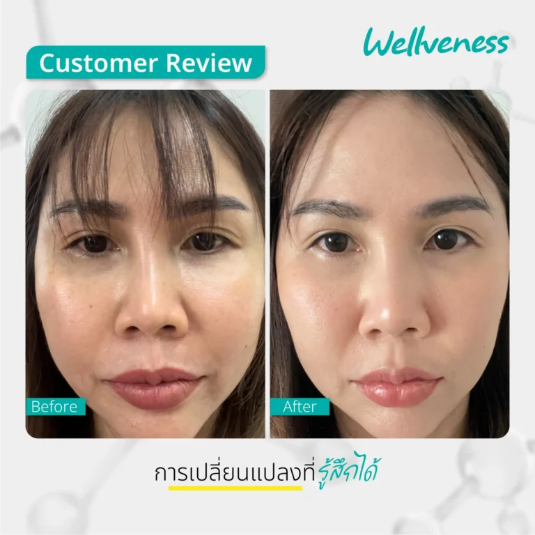 รีวิว ก่อนใช้-หลังใช้ Cucumis By Wellveness Before-After 0002