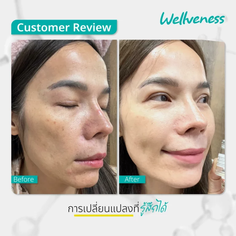 รีวิว ก่อนใช้-หลังใช้ Cucumis By Wellveness Before-After 0004