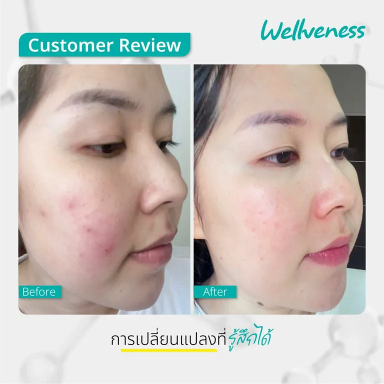 รีวิว ก่อนใช้-หลังใช้ Cucumis By Wellveness Before-After 0005