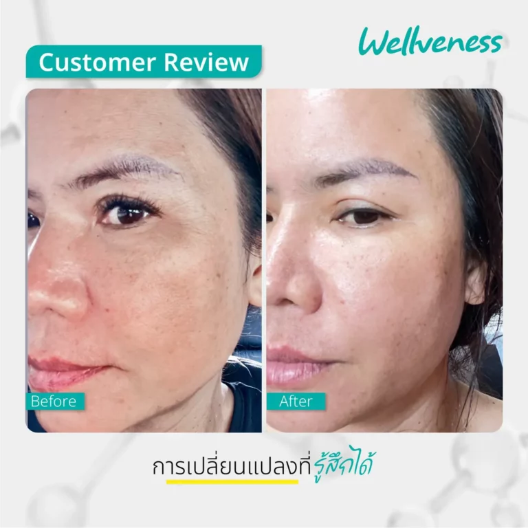 รีวิว ก่อนใช้-หลังใช้ Cucumis By Wellveness Before-After 0006