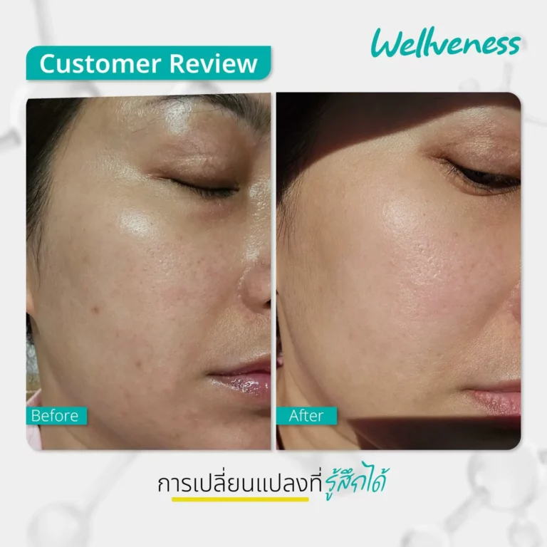 รีวิว ก่อนใช้-หลังใช้ Cucumis By Wellveness Before-After 0007