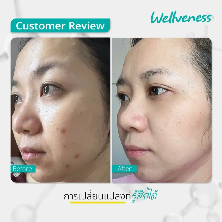 รีวิว ก่อนใช้-หลังใช้ Cucumis By Wellveness Before-After 0008