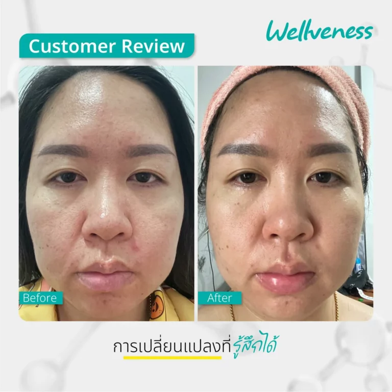 รีวิว ก่อนใช้-หลังใช้ Cucumis By Wellveness Before-After 0009