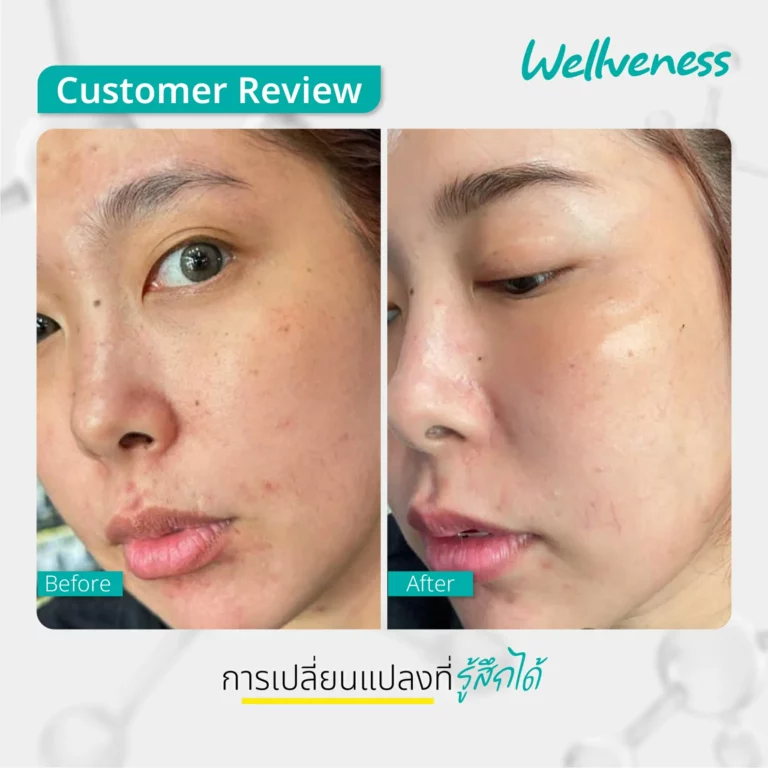 รีวิว ก่อนใช้-หลังใช้ Cucumis By Wellveness Before-After 0010