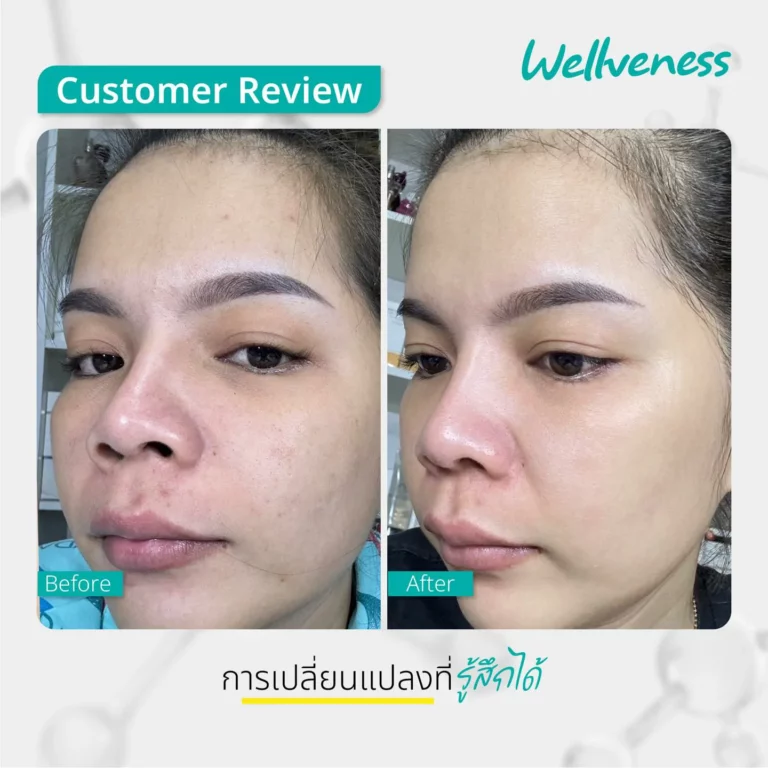 รีวิว ก่อนใช้-หลังใช้ Cucumis By Wellveness Before-After 0012