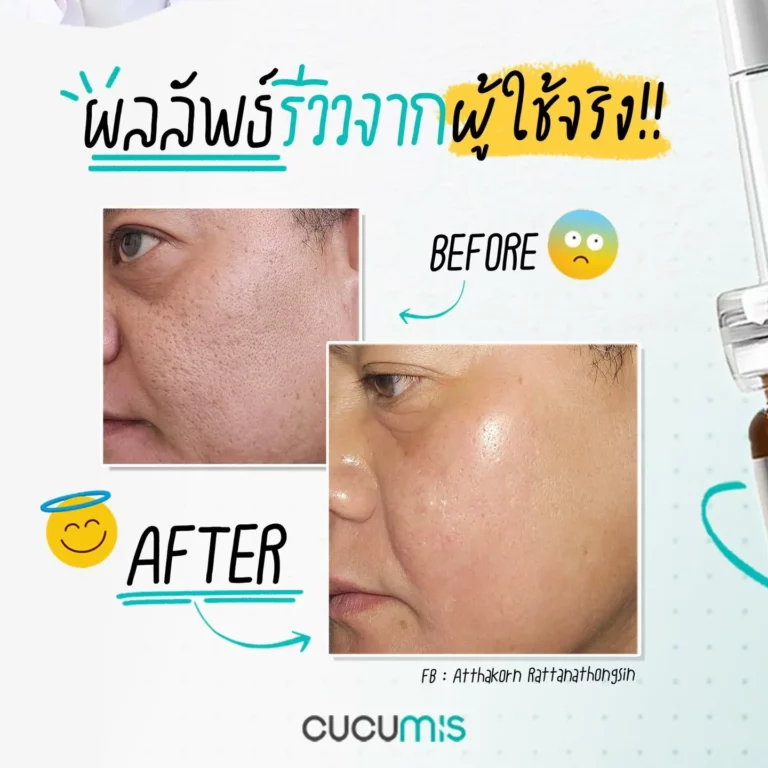 รีวิว ก่อนใช้-หลังใช้ Cucumis By Wellveness Before-After 0015